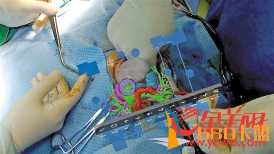 借助混合现实技术，医生们可以将术前重建的虚拟三维心脏影像投射到手术台上方，精确开展手术操作