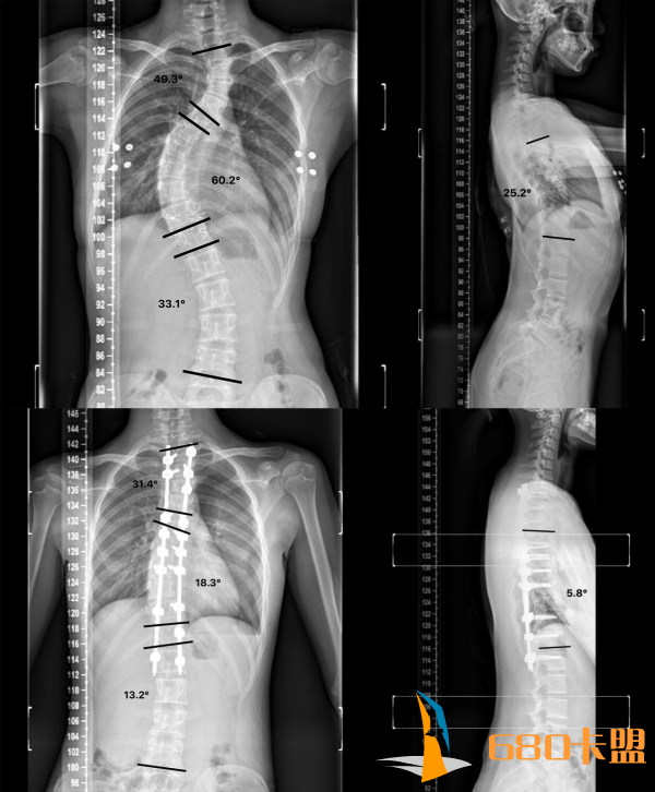 我院骨科完成国际首例绝地求生辅助卡盟机器人辅助下脊柱侧凸微